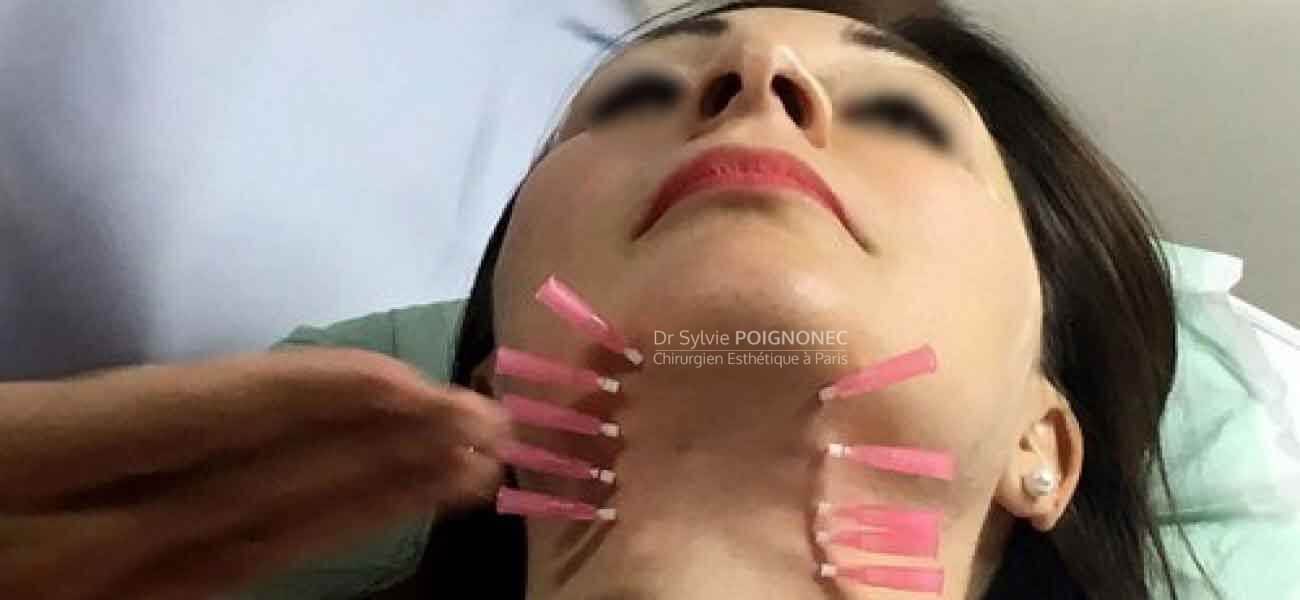 rajeunissement du bas du visage