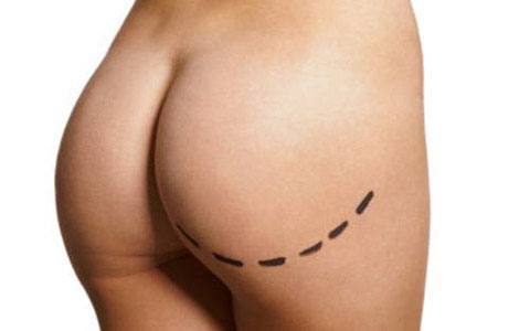 Augmentation des fesses avant après