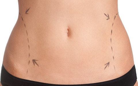 Abdominoplastie avant après