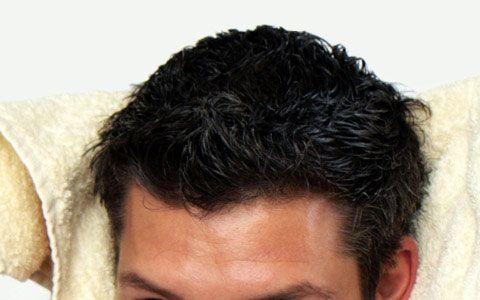 chirurgie esthetique alopecie calvitie
